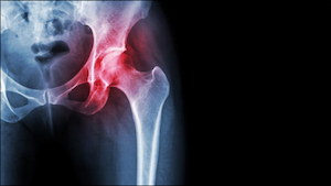 X-Ray of a Hip Joint Inflammation