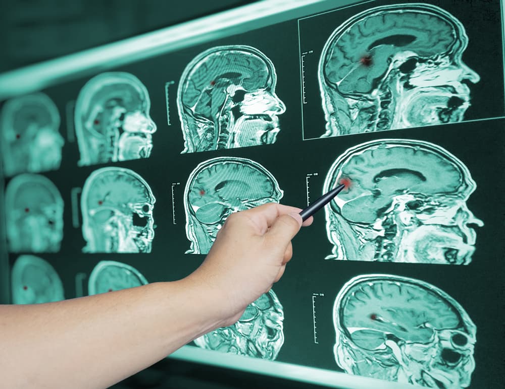 Close-up of a doctor's hand pointing to a brain scan image of a recent traumatic brain injury patient, showing contusions and hemorrhaging. 