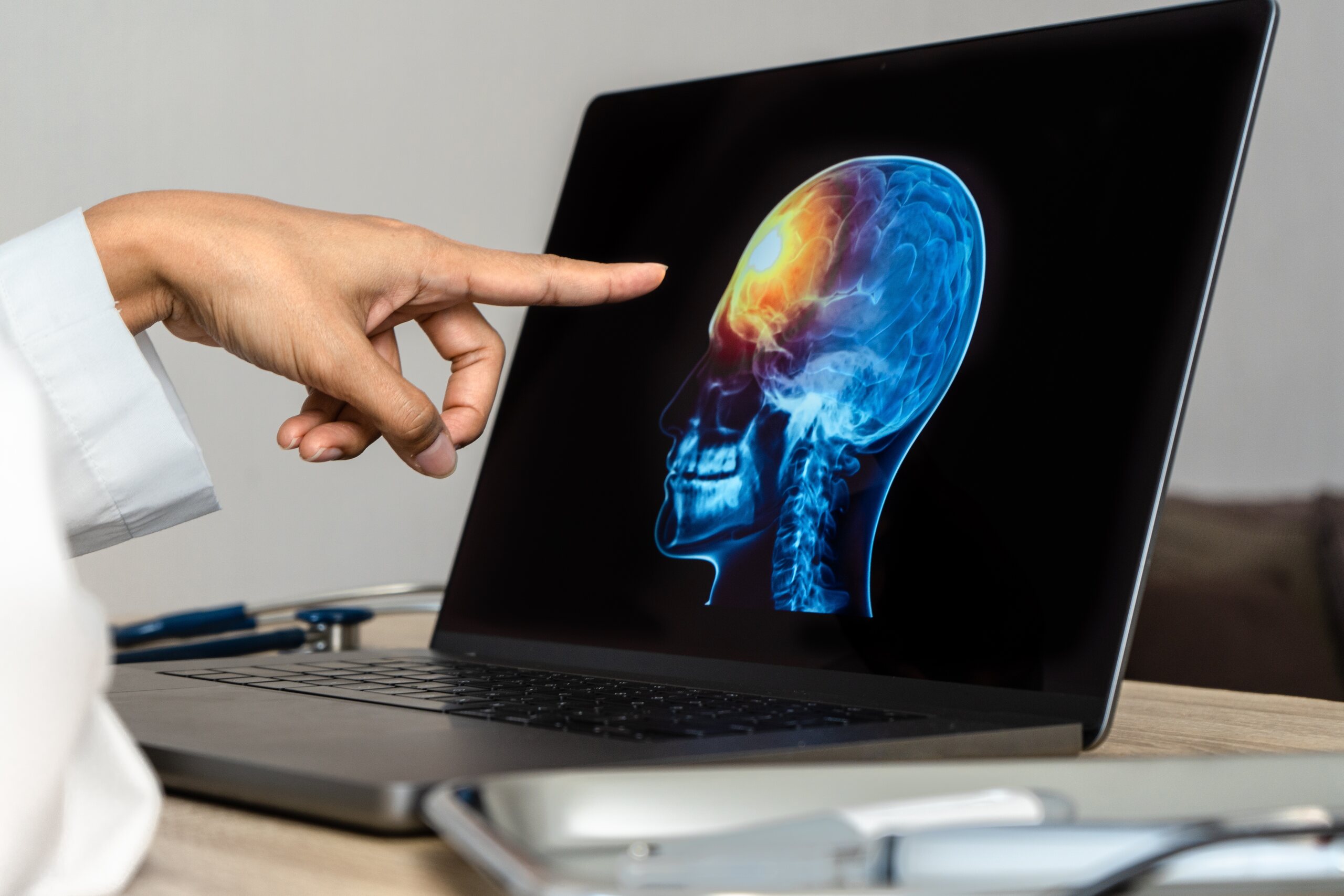 Doctor reviewing brain imaging on a laptop while explaining common traumatic brain injury causes in Florida